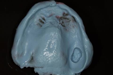 Figure 29. Maxillary special tray definitive impression made in alginate (Dentsply Blueprint) recording depth and width of sulcus.
