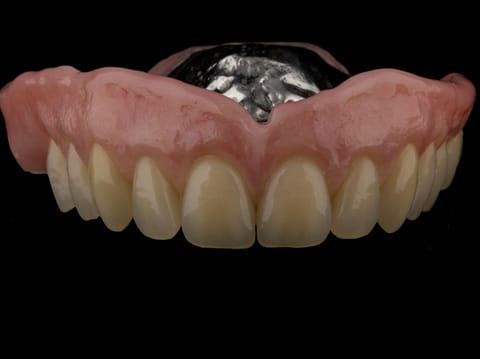 Figure 63. Definitive denture finished - Schottlander Enigmalife teeth
