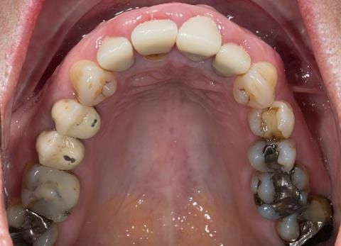 Figure 11. Pre-treatment - occlusal view - upper arch