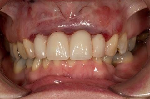 Figure 30. Maxillary immediate denture fitted just after extraction in shown intercuspal position. Schottlander Enigmalife teeth.