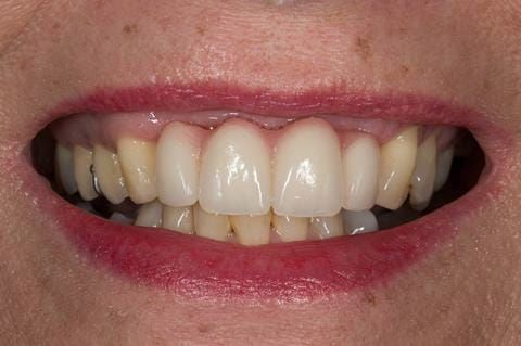 Figure 40. Three months after upper 2- 2 extractions - resorption defect. Ready for chair-side reline.