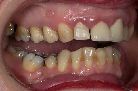 Figure 8. Pre-treatment - upper four incisors with inflammation of the gingivae and mis-match of the gingival levels.