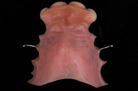 Figure 48. Chair-side reline appointment - 3 months after extractions. The Ufi gel Hard - Voco has been polished labially.