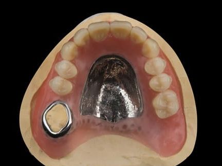 Figure 52. Teeth wax try in with Schottlander Enigmalife teeth.