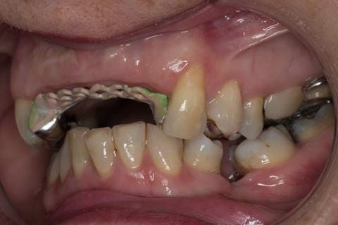 Figure 99. Maxillary cobalt chromium framework trial insertion, checking the occlusion.