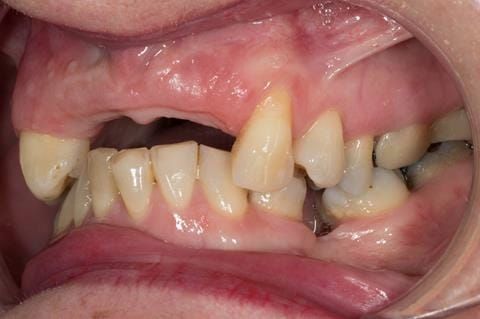 Figure 114. Edentulous ridge 12 months post extraction.