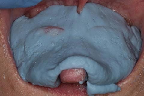 Figure 81. Maxillary special tray definitive impression made in alginate recording depth of the anterior sulcus above the upper 2-2.