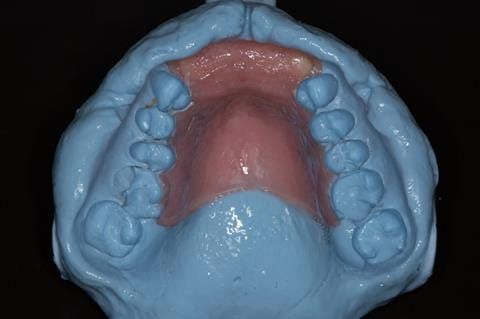 Figure 79. Impression made of immediate denture in situ for Rowan (Dental Technician) to use for copying tooth positions in the definitive denture.