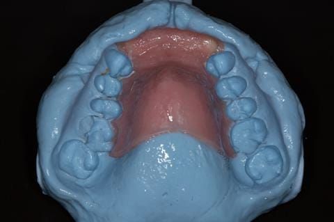 Figure 79. Impression made of immediate denture in situ for Rowan (Dental Technician) to use for copying tooth positions in the definitive denture.