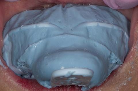 Figure 55. Immediate denture laboratory reline - part 2 alginate over impression in stock tray. Blueprint Dentsply.