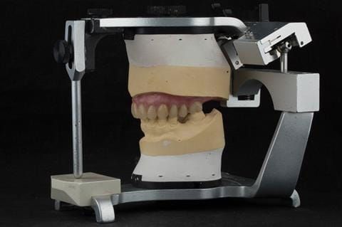 Figure 73. Definitive denture finished with Molloplast B "O" ring around UR7.