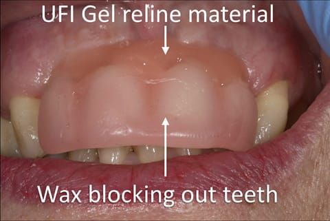 Figure 46. Chair-side reline appointment of interim denture - 3 months after extractions. The denture teeth have been covered with a sheet of wax to prevent reline material (Ufi gel Hard - Voco) from flowing between the teeth.