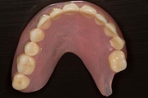 Figure 8. Pre-treatment - poorly fitting acrylic based maxillary partial denture - this denture was not worn