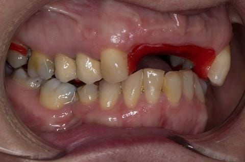 Figure 88. Pattern resin framework prototype of the cobalt chromium connectors to verify fit and occlusal relation - in situ.
