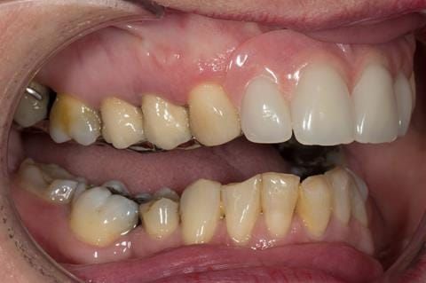 Figure 116. Fitted cobalt chromium based maxillary partial denture with teeth apart. Schottlander Enigmalife teeth.