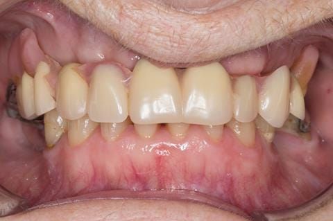 Figure 5. Pre-treatment with poorly fitting cobalt chromium based maxillary partial denture - this was currently worn with the assistance of denture fixative