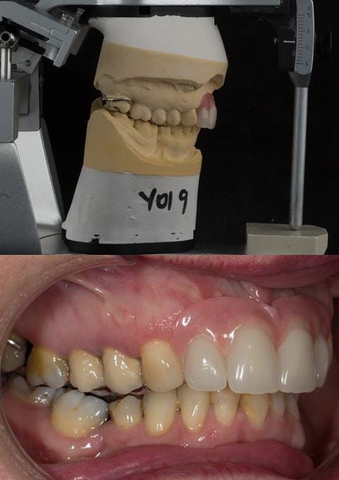 Figure 113. Fitted cobalt chromium based maxillary partial denture replacing upper 2-2 in intercuspal position. Schottlander Enigmalife teeth.