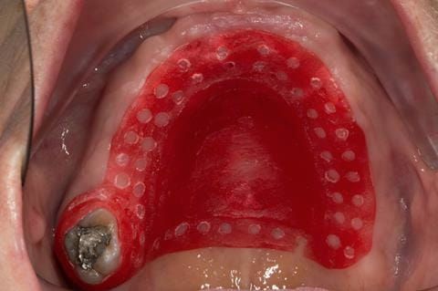 Figure 22. Visit 2 Mock up of cobalt chromium base in pattern resin to try in so that patient can assess where there will be visible metal in final denture.