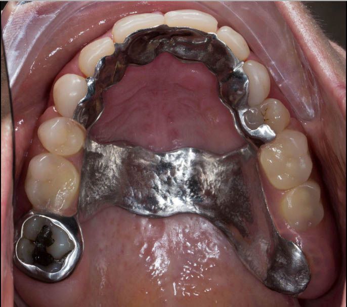 After - conservative management of toothwear with additive composites and upper partial denture splint compressed