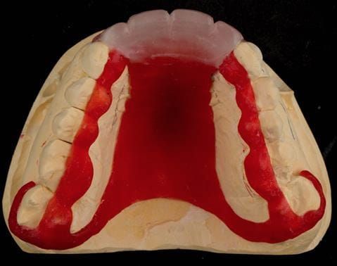 Figure 76. Pattern resin mock up made on primary cast for patient to assess future visible metal.