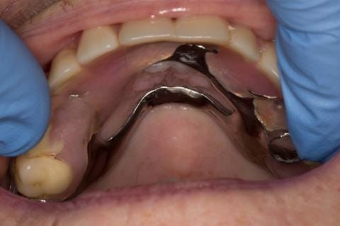 Figure 7. Pre-treatment with poorly fitting cobalt chromium based maxillary partial denture - this was currently worn with the assistance of denture fixative