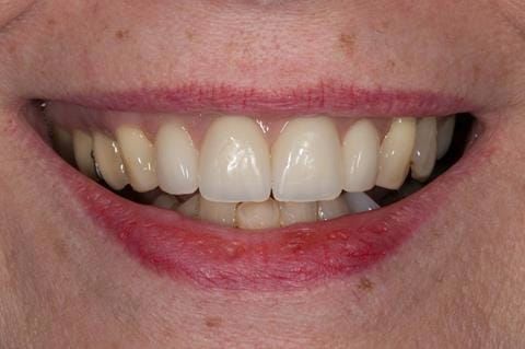 Figure 66. Relined immediate denture replacing maxillary incisors fitted 5 months after extraction.