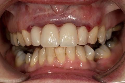 Figure 31. Maxillary immediate denture fitted just after extractionwith teeth apart. Schottlander Enigmalife teeth.