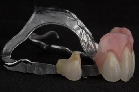 Figure 127. Cobalt chromium based maxillary partial denture from a different case of similar design. The upper right first premolar required removal at a later date. Dental bar designed using a laser welded tag to support the artificial tooth.