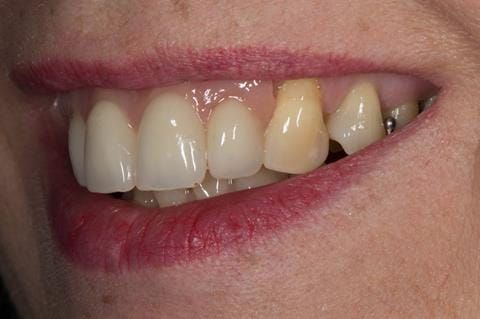 Figure 70. Immediate denture at 11 months post extraction. Ready to start making definitive cobalt chromium based partial denture.