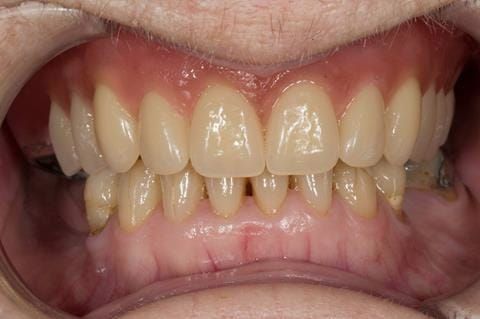 Figure 56. Visit 4 Teeth wax try in with Schottlander Enigmalife teeth in mouth in centric relation position.