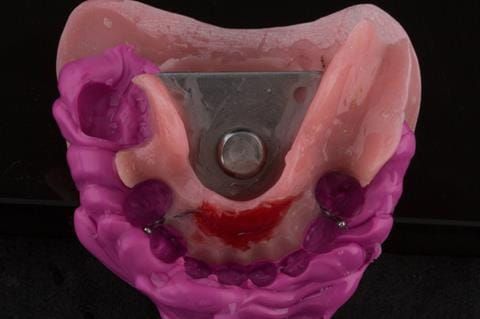 Figure 47. Visit - 3 Central bearing apparatus fixed together with Futar D taken out of the mouth.