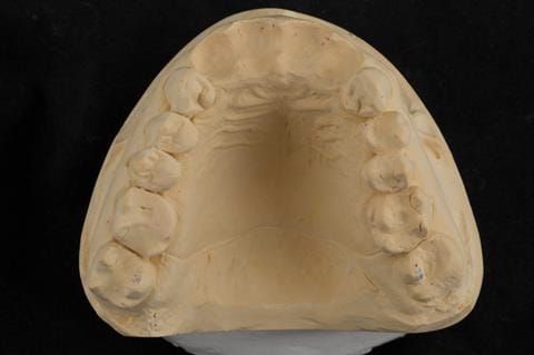 Figure 23. Primary cast of the maxillary arch with upper incisors removed and prepared for ovate pontics and post dam scored into the model.