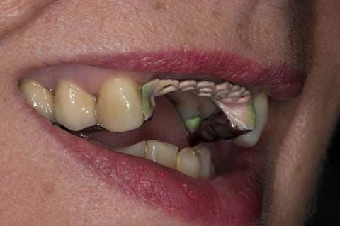 Figure 96. Maxillary cobalt chromium framework trial insertion, checking the fit onto the natural teeth using Occlude spray.