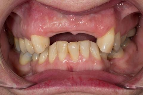 Figure 74. Edentulous ridge 11 months post extraction. Ready to start making definitive cobalt chromium based partial denture.
