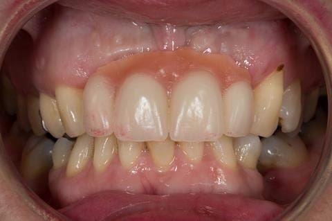 Figure 51. 5 months after extraction of upper 2-2. Immediate denture ready for laboratory reline. Apologises for lipstick on teeth and staining on UL3.