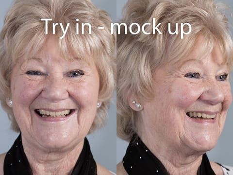 Figure 61. Visit 4 Patient verified mock up, using video trial insertion, still photographs and mirror.