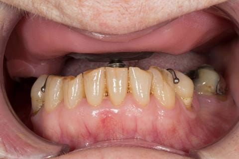 Figure 44. Visit - 3 Central bearing apparatus guided into a countersink hole on the maxillary plate.