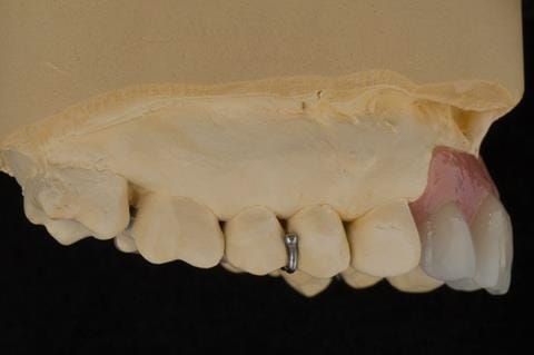 Figure 61. Relined immediate denture on cast.