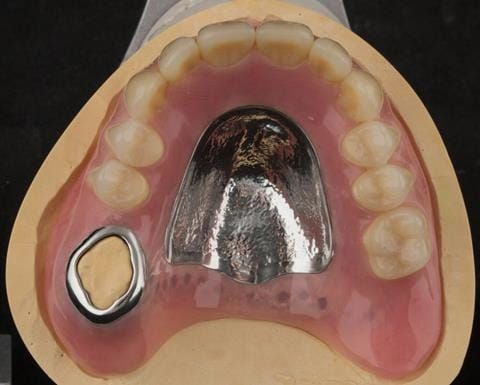 Figure 62. Definitive denture finished with Molloplast B "O" ring around UR7