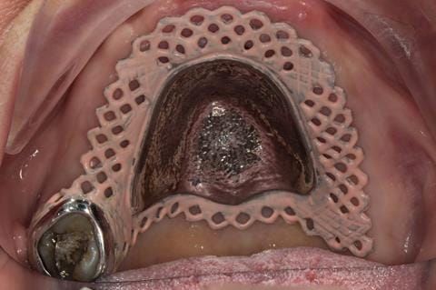 Figure 48. Visit 3 - Cobalt chromium base reinforcement for the maxillary partial denture - Chris Hesketh, Bespoke Frameworks, Chorley, UK.