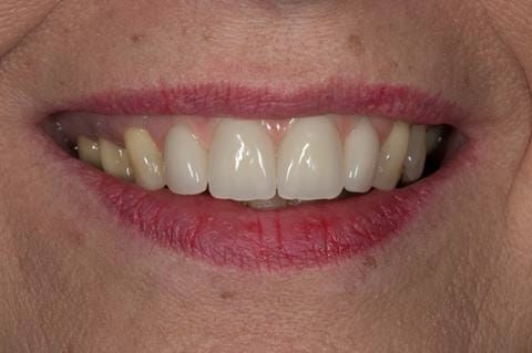Figure 120. Fitted cobalt chromium based maxillary partial denture replacing upper 2-2. Schottlander Enigmalife teeth.