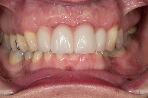 Figure 41. Three months after upper 2- 2 extractions - resorption defect. Ready for chair-side reline.