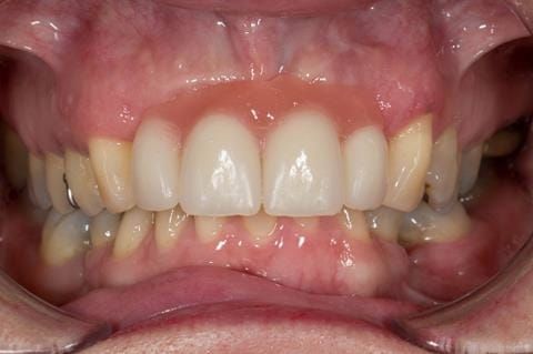 Figure 49. Chair-side reline appointment - 3 months after extractions. The Ufi gel Hard - Voco has been polished and denture fitted. A laboratory reline was scheduled for 5 months post extraction.