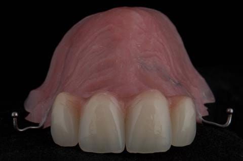 Figure 27. Maxillary immediate partial denture finished with ovate pontics and ball ended clasps. Schottlander Enigmalife teeth.