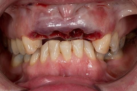 Figure 28. Extraction sites of upper four incisors