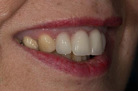 Figure 35. Maxillary immediate denture fitted one week after the extraction appointment.