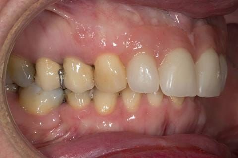 Figure 64. Relined immediate denture replacing maxillary incisors fitted 5 months after extraction.