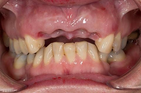 Figure 36. Healing sockets at 1 week review.