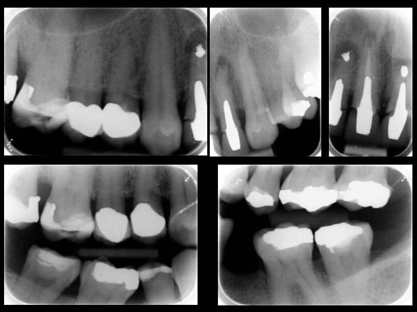 Fig 13. Pre-treatment radiographs. Maxillary incisors with peri-radicular areas. UR2 UL1 retrograde amalgam fillings from previous apicectomies. Large circumferential marginal gaps between the crowns and teeth on UR12, UL12, large posts and cores present.