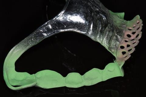Figure 94. Maxillary cobalt chromium framework trial insertion, checking the fit onto the natural teeth using Occlude spray.